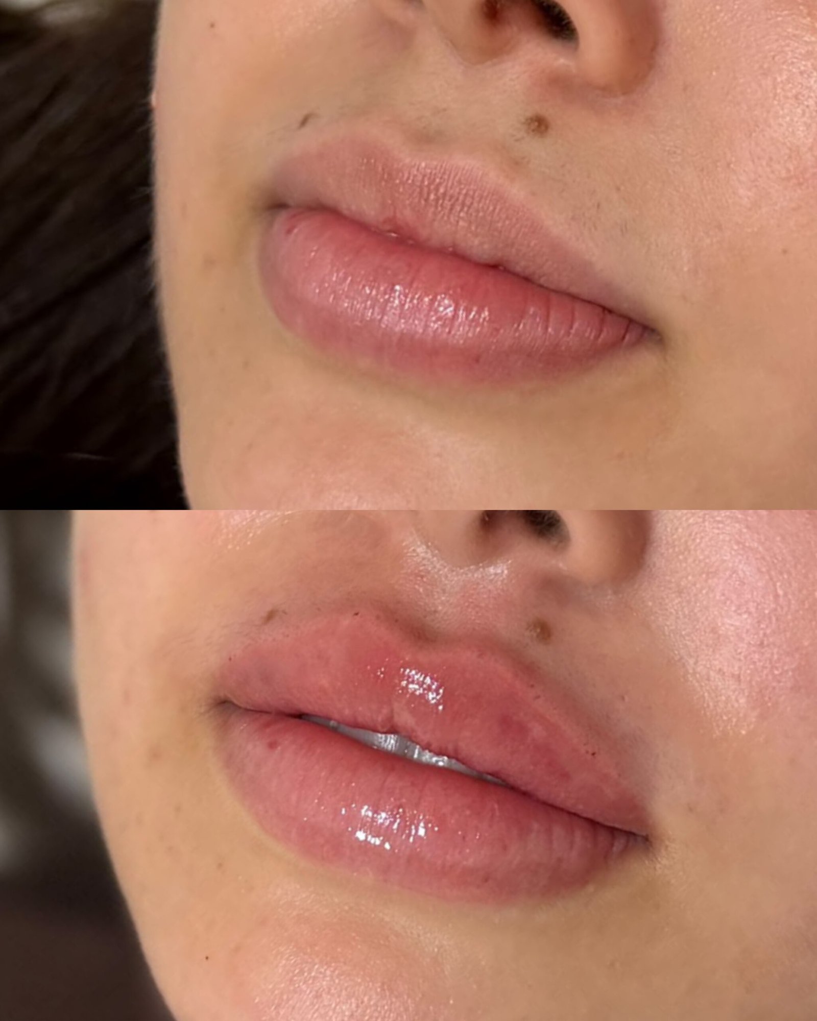 Harmonização Labial - Velaris Concept